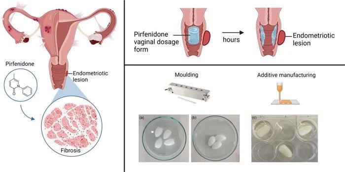 Des ovules imprimés en 3D pour traiter l’endométriose